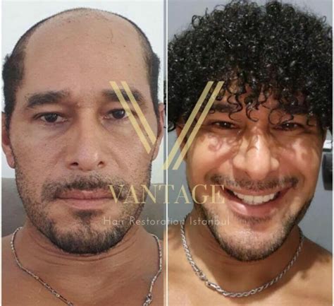 korean hair transplant cost
