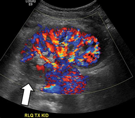 Reason For Renal Artery Ultrasound