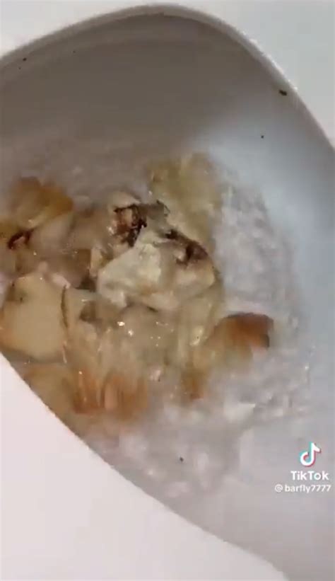 White Mucus In Stool