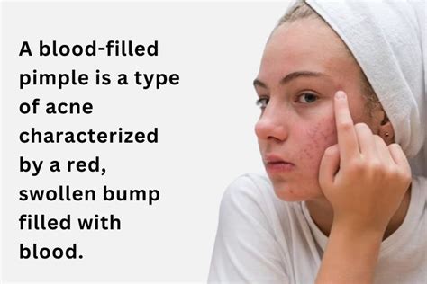 Image result for Blood Red Pimple