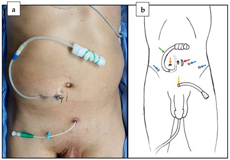 Suprapubic Prostatectomy Prostate Cancer Surgery (Prostatectomy):