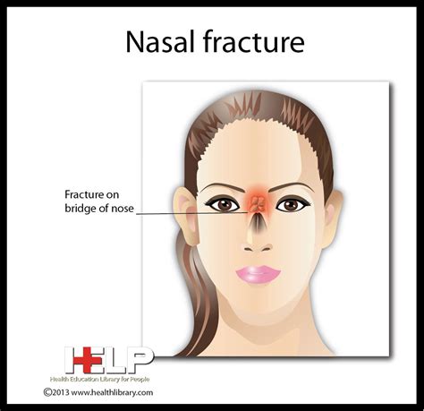 Best 13 Understanding Broken Nose (Nasal Fracture) in Children – Artofit