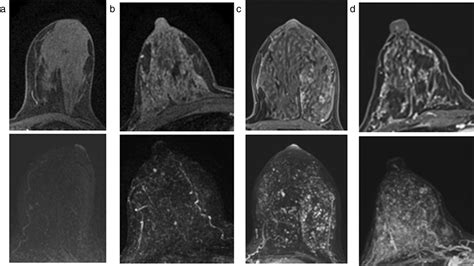 Breast MRI to Screen Women With Extremely Dense Breasts - Sitges - Journal of Magnetic Resonance ...