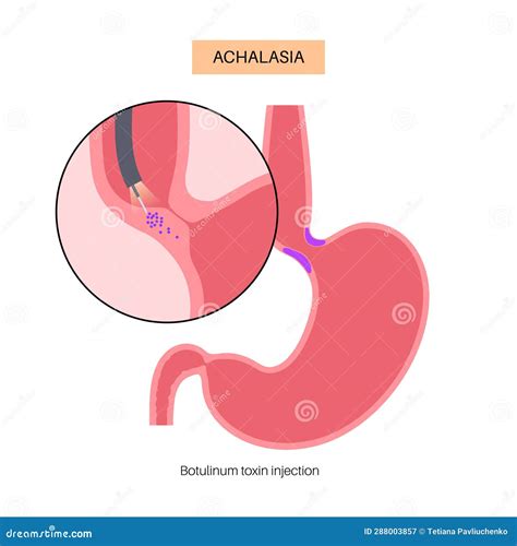 Esophageal Botulinum Toxin Injection Stock Vector - Illustration of ...