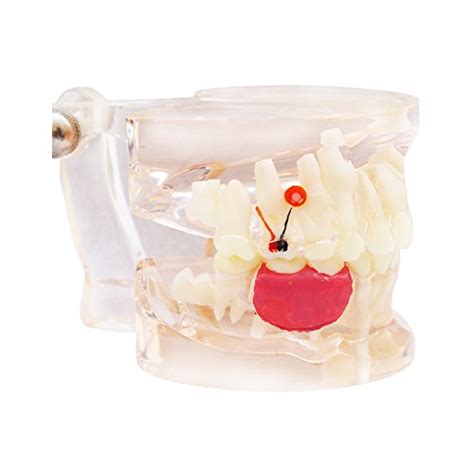 Buy Transparent Missing Deciduous Teeth Model - Medical Science ...