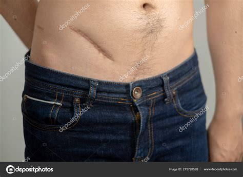 Appendicitis Scar Removal