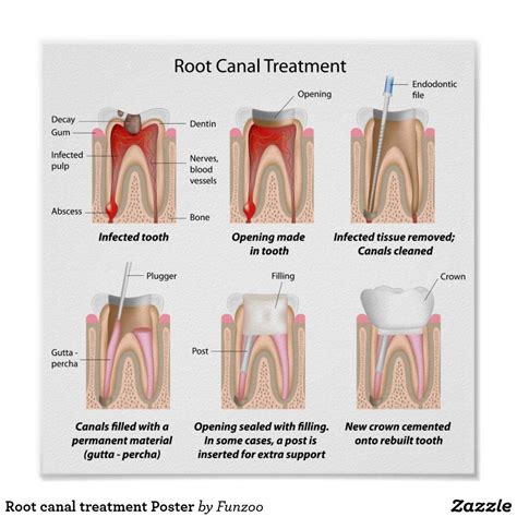 Root Canal Pain Relief: Your Guide to Before, During, and After Treatment - Chaztin