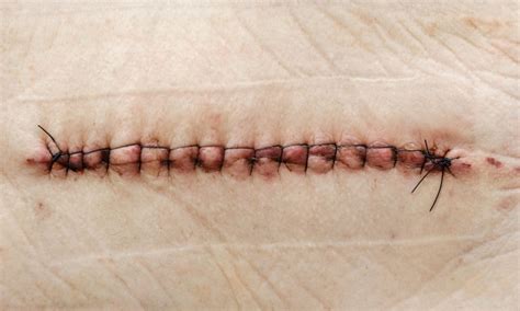 Image result for Common Suture Patterns
