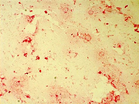 Pathology Outlines - Haemophilus influenzae