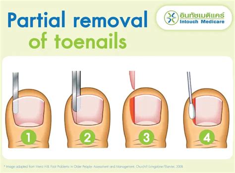 Full Toenail Extraction 的图像结果