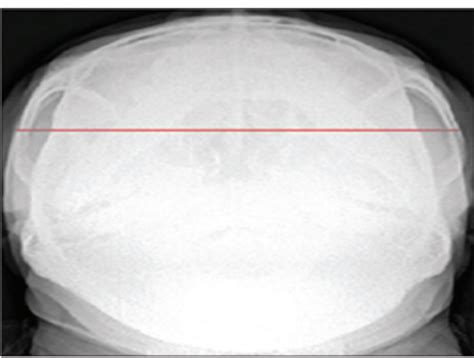 Craniometric Measurement by Jug Handle View: An Aid for Gender ...