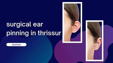 surgical ear pinning in thrissur - topplasticsurgery