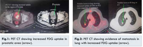 Sarcoma of Prostate of Myofibroblastic Origin