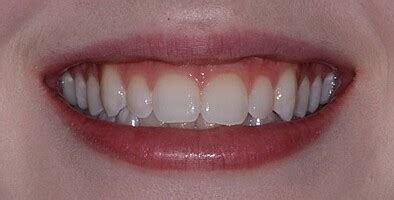 Icon Smooth Surface: Aesthetic treatment of white spots