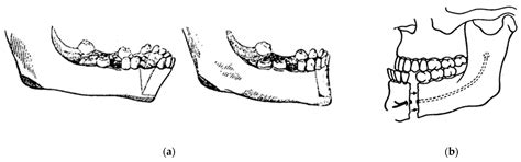 Sixty Years of Innovation in Biomechanical Orthognathic Surgery: The ...