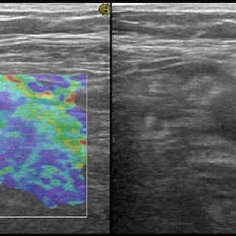 Image result for Dissected Appendix