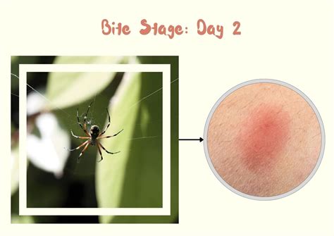 Southern Black Widow Spider Bite: Stages, Symptoms with Pictures