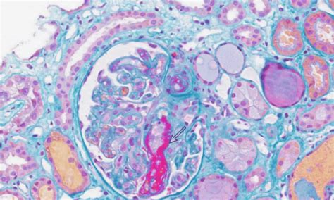 Use of Bevacizumab in Lung Cancer Patient linked to rare kidney ...