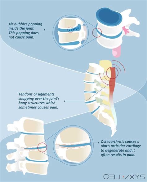 Image result for Popping Lower Back