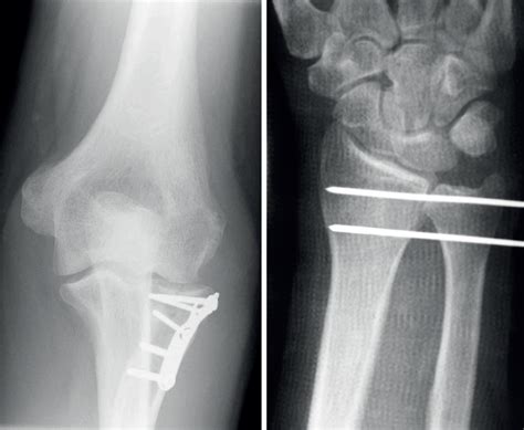 The Essex Lopresti Injury – Fife Virtual Hand Clinic