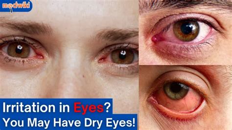 What Causes Dry Eyes All of a Sudden? Causes of Dry and Irritated Eyes ...