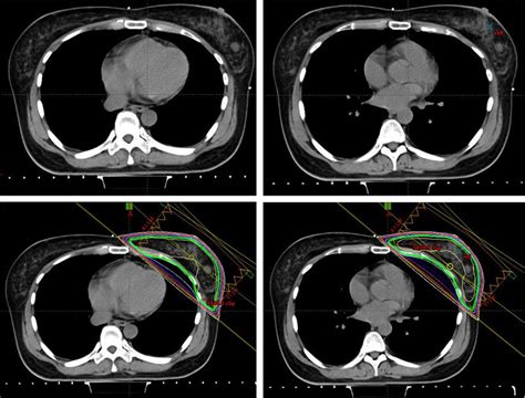 CT Simulation Procedure 的图像结果