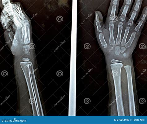 Plain X Ray Right Wrist Joint Shows Right Distal Radius Fracture ...
