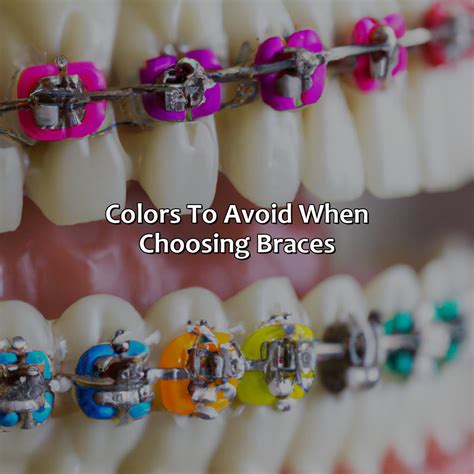 What Color Braces Will Make Your Teeth Look White at Larry Hinojosa blog