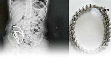 女童误吞61颗磁力珠 导致14处肠穿孔 | 马来西亚诗华日报新闻网