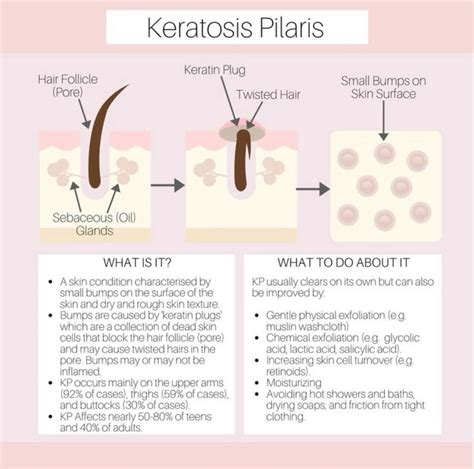 How to remove an ingrown hair cyst on bikini line – Artofit