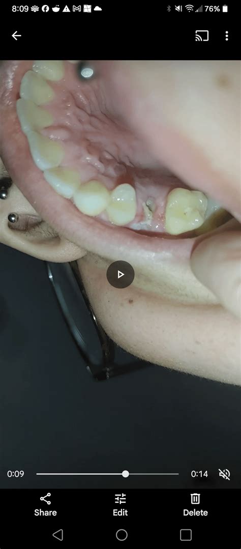 Image result for Infected Tooth Extraction Aftercare