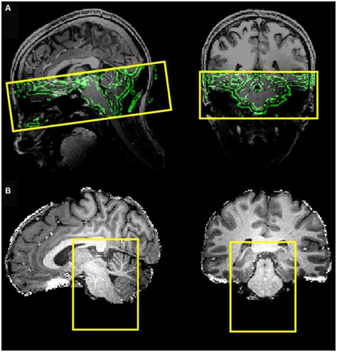 Frontiers | Functional MRI activation of the nucleus tractus solitarius after taste stimuli at ...
