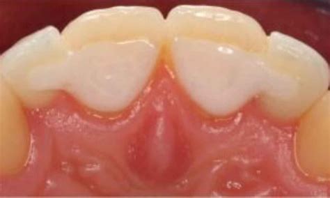 Direct composite bests zirconia resin-bonded fixed dental prostheses ...