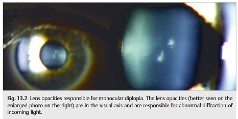 Image result for Intractable Diplopia