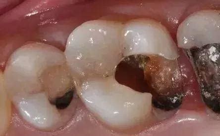 牙齒蛀牙後放任不管，會有哪些不良影響？ - 每日頭條