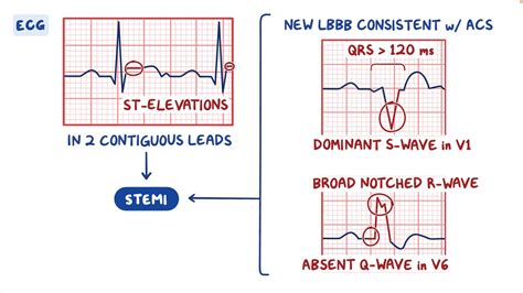 Non Stemi Vs Nstemi
