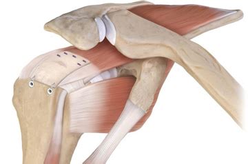 Rotator Cuff Tear Surgery Treatment in Rajasthan | Dr. Vikram Sharma