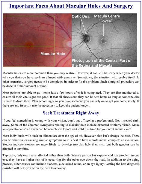 Macular Hole Surgery