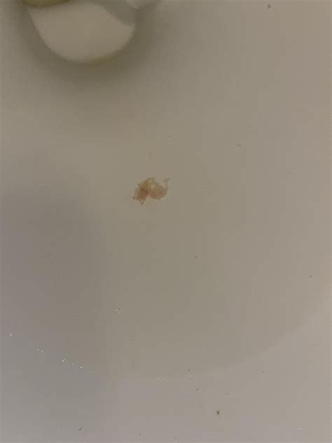 White tissue in urine with extreme pain : r/KidneyStones
