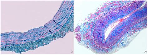 The Controversy of Using Insufficient Great Saphenous Veins in Coronary ...