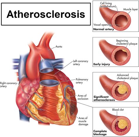 Atherosclerosis - Causes, Risk Factors, Symptoms, Diagnosis & Treatment