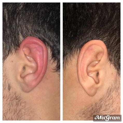 Kuvatulokset haulle cauliflower ear