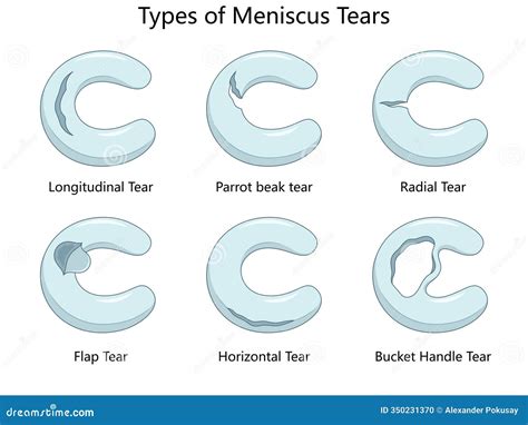 Medial Meniscus Tear - Horizontal - Right Leg - Type 1