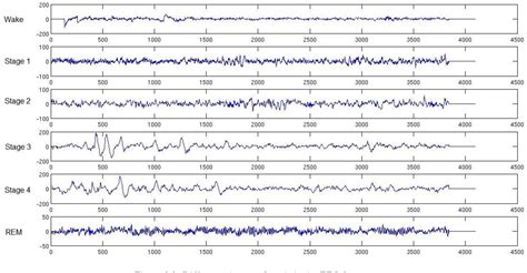 Narcolepsy Sleep Cycle Graph 的图像结果