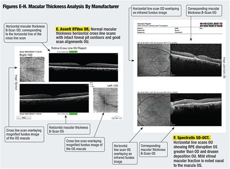 Image result for How to Use the Oct Scan in Optometry