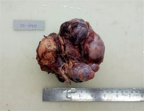 Seromucinous carcinoma of ovary - A rare entity - Indian J Pathol Oncol