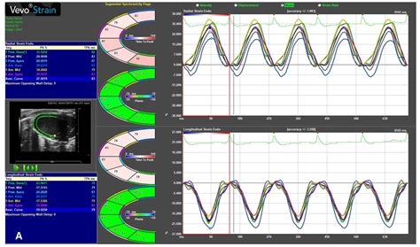 Echocardiographic Assessment of Cardiac Function in Mouse Models of ...