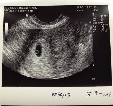 Albums 90+ Pictures 5 Weeks 4 Days Pregnant Ultrasound Pictures Sharp