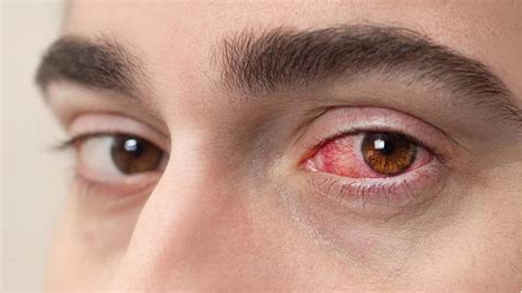 Can Eye Strain Cause Puffy Eyes at Patricia Bouchard blog