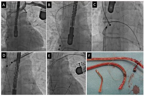 VDD Lead Extraction—Differences with Other Leads and Practical Tips in ...